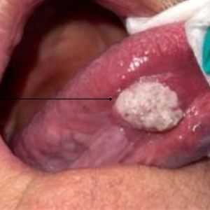 Thick White Patches in the Mouth